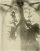 An illustration from Bismuth paste in chronic suppurations : its diagnostic importance and therapeutic value / by Emil G. Beck ... with an introduction by Carl Beck, M. D., and a chapter on the application of bismuth paste in the treatment of chronic suppuration of the nasal accessory sinuses and the ear, by Joseph C. Beck, M. D. With eighty-one engravings, nine diagrammatic illustrations, and a colored plate. (1914)