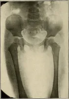An illustration from Bismuth paste in chronic suppurations : its diagnostic importance and therapeutic value / by Emil G. Beck ... with an introduction by Carl Beck, M. D., and a chapter on the application of bismuth paste in the treatment of chronic suppuration of the nasal accessory sinuses and the ear, by Joseph C. Beck, M. D. With eighty-one engravings, nine diagrammatic illustrations, and a colored plate. (1914)