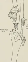 An illustration from Bismuth paste in chronic suppurations : its diagnostic importance and therapeutic value / by Emil G. Beck ... with an introduction by Carl Beck, M. D., and a chapter on the application of bismuth paste in the treatment of chronic suppuration of the nasal accessory sinuses and the ear, by Joseph C. Beck, M. D. With eighty-one engravings, nine diagrammatic illustrations, and a colored plate. (1914)