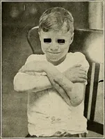 An illustration from Bismuth paste in chronic suppurations : its diagnostic importance and therapeutic value / by Emil G. Beck ... with an introduction by Carl Beck, M. D., and a chapter on the application of bismuth paste in the treatment of chronic suppuration of the nasal accessory sinuses and the ear, by Joseph C. Beck, M. D. With eighty-one engravings, nine diagrammatic illustrations, and a colored plate. (1914)