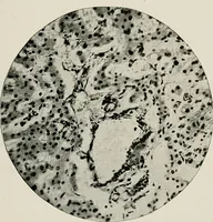 An illustration from Bismuth paste in chronic suppurations : its diagnostic importance and therapeutic value / by Emil G. Beck ... with an introduction by Carl Beck, M. D., and a chapter on the application of bismuth paste in the treatment of chronic suppuration of the nasal accessory sinuses and the ear, by Joseph C. Beck, M. D. With eighty-one engravings, nine diagrammatic illustrations, and a colored plate. (1914)