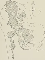 An illustration from Bismuth paste in chronic suppurations : its diagnostic importance and therapeutic value / by Emil G. Beck ... with an introduction by Carl Beck, M. D., and a chapter on the application of bismuth paste in the treatment of chronic suppuration of the nasal accessory sinuses and the ear, by Joseph C. Beck, M. D. With eighty-one engravings, nine diagrammatic illustrations, and a colored plate. (1914)