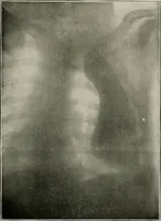 An illustration from Bismuth paste in chronic suppurations : its diagnostic importance and therapeutic value / by Emil G. Beck ... with an introduction by Carl Beck, M. D., and a chapter on the application of bismuth paste in the treatment of chronic suppuration of the nasal accessory sinuses and the ear, by Joseph C. Beck, M. D. With eighty-one engravings, nine diagrammatic illustrations, and a colored plate. (1914)