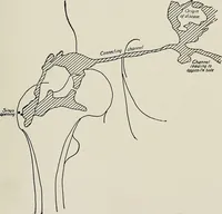 An illustration from Bismuth paste in chronic suppurations : its diagnostic importance and therapeutic value / by Emil G. Beck ... with an introduction by Carl Beck, M. D., and a chapter on the application of bismuth paste in the treatment of chronic suppuration of the nasal accessory sinuses and the ear, by Joseph C. Beck, M. D. With eighty-one engravings, nine diagrammatic illustrations, and a colored plate. (1914)