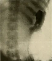 An illustration from Bismuth paste in chronic suppurations : its diagnostic importance and therapeutic value / by Emil G. Beck ... with an introduction by Carl Beck, M. D., and a chapter on the application of bismuth paste in the treatment of chronic suppuration of the nasal accessory sinuses and the ear, by Joseph C. Beck, M. D. With eighty-one engravings, nine diagrammatic illustrations, and a colored plate. (1914)
