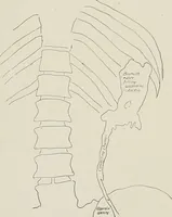 An illustration from Bismuth paste in chronic suppurations : its diagnostic importance and therapeutic value / by Emil G. Beck ... with an introduction by Carl Beck, M. D., and a chapter on the application of bismuth paste in the treatment of chronic suppuration of the nasal accessory sinuses and the ear, by Joseph C. Beck, M. D. With eighty-one engravings, nine diagrammatic illustrations, and a colored plate. (1914)