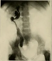 An illustration from Bismuth paste in chronic suppurations : its diagnostic importance and therapeutic value / by Emil G. Beck ... with an introduction by Carl Beck, M. D., and a chapter on the application of bismuth paste in the treatment of chronic suppuration of the nasal accessory sinuses and the ear, by Joseph C. Beck, M. D. With eighty-one engravings, nine diagrammatic illustrations, and a colored plate. (1914)