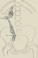 An illustration from Bismuth paste in chronic suppurations : its diagnostic importance and therapeutic value / by Emil G. Beck ... with an introduction by Carl Beck, M. D., and a chapter on the application of bismuth paste in the treatment of chronic suppuration of the nasal accessory sinuses and the ear, by Joseph C. Beck, M. D. With eighty-one engravings, nine diagrammatic illustrations, and a colored plate. (1914)
