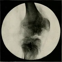 An illustration from Bismuth paste in chronic suppurations : its diagnostic importance and therapeutic value / by Emil G. Beck ... with an introduction by Carl Beck, M. D., and a chapter on the application of bismuth paste in the treatment of chronic suppuration of the nasal accessory sinuses and the ear, by Joseph C. Beck, M. D. With eighty-one engravings, nine diagrammatic illustrations, and a colored plate. (1914)