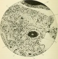 An illustration from An American text-book of genito-urinary diseases, syphilis and diseases of the skin / Ed. by L. Bolton Bangs ... and W. A. Hardaway ... Illustrated with 300 engravings and 20 full-page colored plates. (1898)