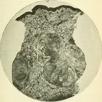 An illustration from An American text-book of genito-urinary diseases, syphilis and diseases of the skin / Ed. by L. Bolton Bangs ... and W. A. Hardaway ... Illustrated with 300 engravings and 20 full-page colored plates. (1898)