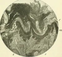 An illustration from An American text-book of genito-urinary diseases, syphilis and diseases of the skin / Ed. by L. Bolton Bangs ... and W. A. Hardaway ... Illustrated with 300 engravings and 20 full-page colored plates. (1898)