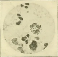 An illustration from An American text-book of genito-urinary diseases, syphilis and diseases of the skin / Ed. by L. Bolton Bangs ... and W. A. Hardaway ... Illustrated with 300 engravings and 20 full-page colored plates. (1898)