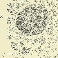 An illustration from An American text-book of genito-urinary diseases, syphilis and diseases of the skin / Ed. by L. Bolton Bangs ... and W. A. Hardaway ... Illustrated with 300 engravings and 20 full-page colored plates. (1898)