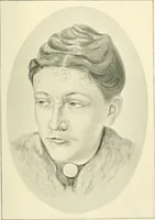 An illustration from An American text-book of genito-urinary diseases, syphilis and diseases of the skin / Ed. by L. Bolton Bangs ... and W. A. Hardaway ... Illustrated with 300 engravings and 20 full-page colored plates. (1898)