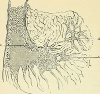 An illustration from An American text-book of genito-urinary diseases, syphilis and diseases of the skin / Ed. by L. Bolton Bangs ... and W. A. Hardaway ... Illustrated with 300 engravings and 20 full-page colored plates. (1898)