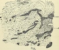 An illustration from An American text-book of genito-urinary diseases, syphilis and diseases of the skin / Ed. by L. Bolton Bangs ... and W. A. Hardaway ... Illustrated with 300 engravings and 20 full-page colored plates. (1898)