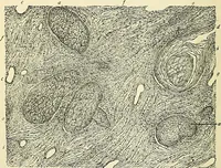 An illustration from An American text-book of genito-urinary diseases, syphilis and diseases of the skin / Ed. by L. Bolton Bangs ... and W. A. Hardaway ... Illustrated with 300 engravings and 20 full-page colored plates. (1898)