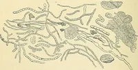 An illustration from An American text-book of genito-urinary diseases, syphilis and diseases of the skin / Ed. by L. Bolton Bangs ... and W. A. Hardaway ... Illustrated with 300 engravings and 20 full-page colored plates. (1898)
