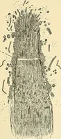 An illustration from An American text-book of genito-urinary diseases, syphilis and diseases of the skin / Ed. by L. Bolton Bangs ... and W. A. Hardaway ... Illustrated with 300 engravings and 20 full-page colored plates. (1898)