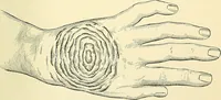 An illustration from An American text-book of genito-urinary diseases, syphilis and diseases of the skin / Ed. by L. Bolton Bangs ... and W. A. Hardaway ... Illustrated with 300 engravings and 20 full-page colored plates. (1898)