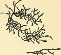 An illustration from An American text-book of genito-urinary diseases, syphilis and diseases of the skin / Ed. by L. Bolton Bangs ... and W. A. Hardaway ... Illustrated with 300 engravings and 20 full-page colored plates. (1898)