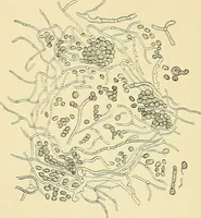 An illustration from An American text-book of genito-urinary diseases, syphilis and diseases of the skin / Ed. by L. Bolton Bangs ... and W. A. Hardaway ... Illustrated with 300 engravings and 20 full-page colored plates. (1898)