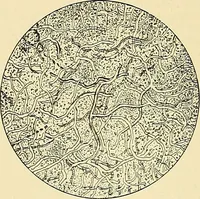 An illustration from An American text-book of genito-urinary diseases, syphilis and diseases of the skin / Ed. by L. Bolton Bangs ... and W. A. Hardaway ... Illustrated with 300 engravings and 20 full-page colored plates. (1898)