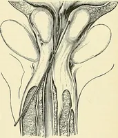 An illustration from An American text-book of genito-urinary diseases, syphilis and diseases of the skin / Ed. by L. Bolton Bangs ... and W. A. Hardaway ... Illustrated with 300 engravings and 20 full-page colored plates. (1898)