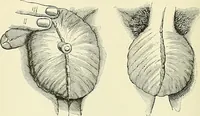 An illustration from An American text-book of genito-urinary diseases, syphilis and diseases of the skin / Ed. by L. Bolton Bangs ... and W. A. Hardaway ... Illustrated with 300 engravings and 20 full-page colored plates. (1898)