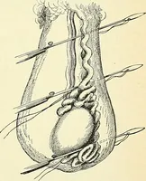 An illustration from An American text-book of genito-urinary diseases, syphilis and diseases of the skin / Ed. by L. Bolton Bangs ... and W. A. Hardaway ... Illustrated with 300 engravings and 20 full-page colored plates. (1898)