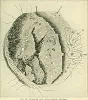 Picture 31 of 146 from An American text-book of genito-urinary diseases, syphilis and diseases of the skin / Ed. by L. Bolton Bangs ... and W. A. Hardaway ... Illustrated with 300 engravings and 20 full-page colored plates. (1898), leaf 263
