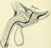 An illustration from An American text-book of genito-urinary diseases, syphilis and diseases of the skin / Ed. by L. Bolton Bangs ... and W. A. Hardaway ... Illustrated with 300 engravings and 20 full-page colored plates. (1898)