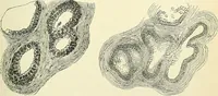 An illustration from An American text-book of genito-urinary diseases, syphilis and diseases of the skin / Ed. by L. Bolton Bangs ... and W. A. Hardaway ... Illustrated with 300 engravings and 20 full-page colored plates. (1898)