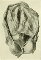 An illustration from An American text-book of genito-urinary diseases, syphilis and diseases of the skin / Ed. by L. Bolton Bangs ... and W. A. Hardaway ... Illustrated with 300 engravings and 20 full-page colored plates. (1898)