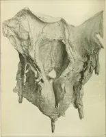 An illustration from An American text-book of genito-urinary diseases, syphilis and diseases of the skin / Ed. by L. Bolton Bangs ... and W. A. Hardaway ... Illustrated with 300 engravings and 20 full-page colored plates. (1898)