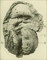 Picture 37 of 146 from An American text-book of genito-urinary diseases, syphilis and diseases of the skin / Ed. by L. Bolton Bangs ... and W. A. Hardaway ... Illustrated with 300 engravings and 20 full-page colored plates. (1898), leaf 285