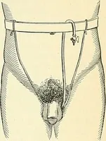 Picture 42 of 146 from An American text-book of genito-urinary diseases, syphilis and diseases of the skin / Ed. by L. Bolton Bangs ... and W. A. Hardaway ... Illustrated with 300 engravings and 20 full-page colored plates. (1898), leaf 311
