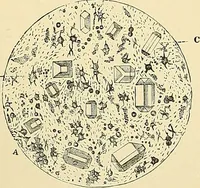 An illustration from An American text-book of genito-urinary diseases, syphilis and diseases of the skin / Ed. by L. Bolton Bangs ... and W. A. Hardaway ... Illustrated with 300 engravings and 20 full-page colored plates. (1898)