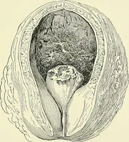 An illustration from An American text-book of genito-urinary diseases, syphilis and diseases of the skin / Ed. by L. Bolton Bangs ... and W. A. Hardaway ... Illustrated with 300 engravings and 20 full-page colored plates. (1898)