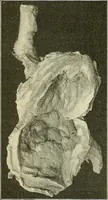 An illustration from An American text-book of genito-urinary diseases, syphilis and diseases of the skin / Ed. by L. Bolton Bangs ... and W. A. Hardaway ... Illustrated with 300 engravings and 20 full-page colored plates. (1898)