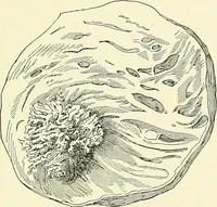 An illustration from An American text-book of genito-urinary diseases, syphilis and diseases of the skin / Ed. by L. Bolton Bangs ... and W. A. Hardaway ... Illustrated with 300 engravings and 20 full-page colored plates. (1898)