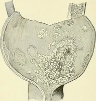 An illustration from An American text-book of genito-urinary diseases, syphilis and diseases of the skin / Ed. by L. Bolton Bangs ... and W. A. Hardaway ... Illustrated with 300 engravings and 20 full-page colored plates. (1898)