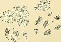 An illustration from An American text-book of genito-urinary diseases, syphilis and diseases of the skin / Ed. by L. Bolton Bangs ... and W. A. Hardaway ... Illustrated with 300 engravings and 20 full-page colored plates. (1898)