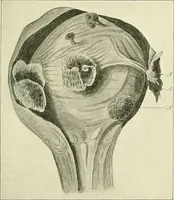 An illustration from An American text-book of genito-urinary diseases, syphilis and diseases of the skin / Ed. by L. Bolton Bangs ... and W. A. Hardaway ... Illustrated with 300 engravings and 20 full-page colored plates. (1898)