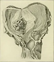 An illustration from An American text-book of genito-urinary diseases, syphilis and diseases of the skin / Ed. by L. Bolton Bangs ... and W. A. Hardaway ... Illustrated with 300 engravings and 20 full-page colored plates. (1898)