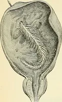 An illustration from An American text-book of genito-urinary diseases, syphilis and diseases of the skin / Ed. by L. Bolton Bangs ... and W. A. Hardaway ... Illustrated with 300 engravings and 20 full-page colored plates. (1898)