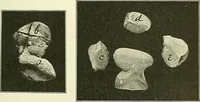 An illustration from An American text-book of genito-urinary diseases, syphilis and diseases of the skin / Ed. by L. Bolton Bangs ... and W. A. Hardaway ... Illustrated with 300 engravings and 20 full-page colored plates. (1898)