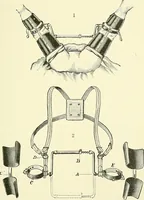 An illustration from An American text-book of genito-urinary diseases, syphilis and diseases of the skin / Ed. by L. Bolton Bangs ... and W. A. Hardaway ... Illustrated with 300 engravings and 20 full-page colored plates. (1898)