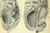 An illustration from An American text-book of genito-urinary diseases, syphilis and diseases of the skin / Ed. by L. Bolton Bangs ... and W. A. Hardaway ... Illustrated with 300 engravings and 20 full-page colored plates. (1898)